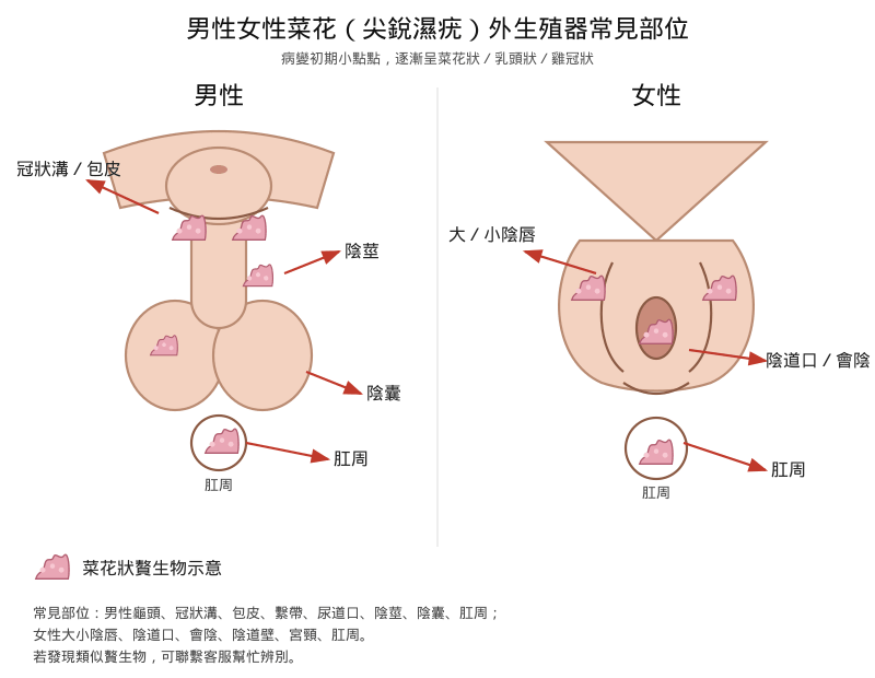 男性女性外生殖器菜花（尖銳湿疣）
